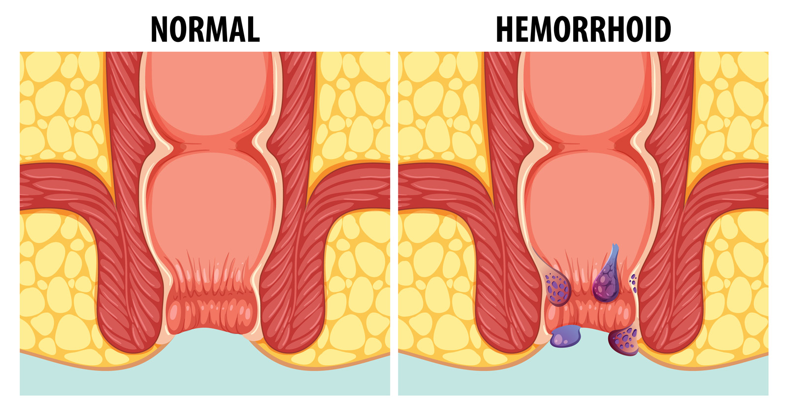 cause of hemorrhoids hemocyl treattment oral capsules, hemorrhoids health center